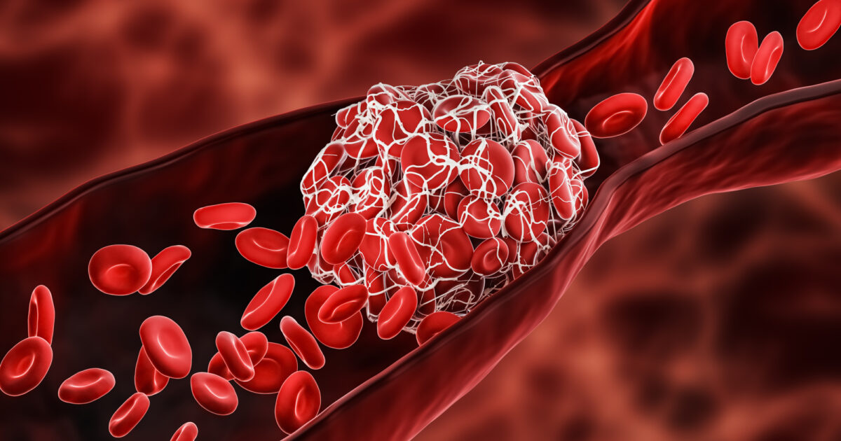 do cigarettes cause blood clots Blood clot symptoms and causes • Heart Research Institute